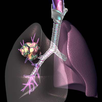 El cáncer de pulmón es el segundo cáncer más común en Venezuela