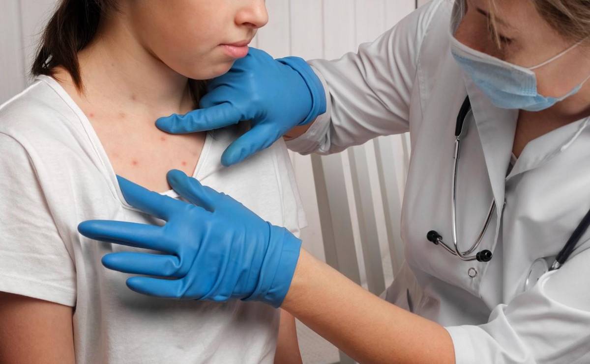 Los casos confirmados de sarampión en el estallido de epidemia en Paraguay se elevan a 16